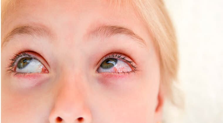 Conjuntivitis