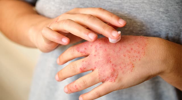 Dermatitis atópica