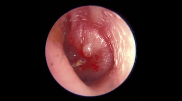 Otitis media